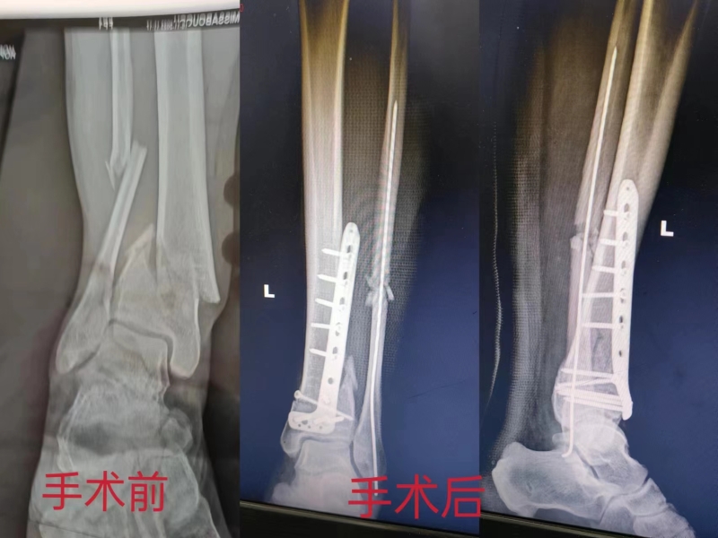 手术部位的反复刺激